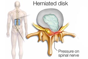 minimal invasive spine surgery jalandhar