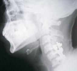 spine surgery in moga