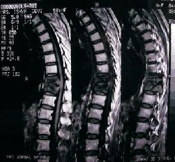 spine surgery moga