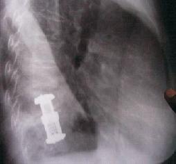 spine surgery cost in gurdaspur