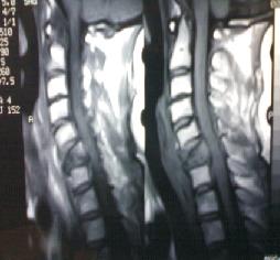 spine surgery cost jalandhar